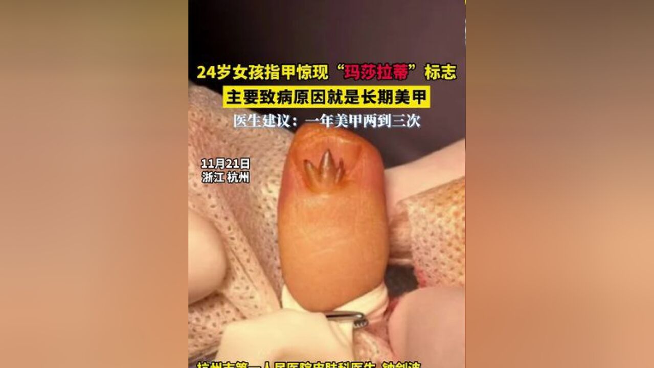 24岁女孩指甲惊现“玛莎拉蒂”标志 主要致病原因就是长期美甲 医生建议:一年美甲两到三次