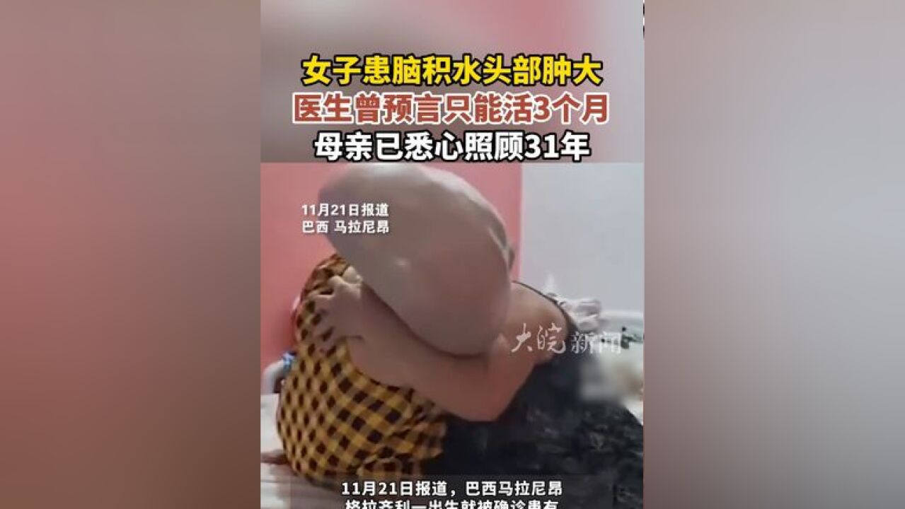 女子患脑积水头部肿大 医生曾预言只能活3个月 母亲已悉心照顾31年