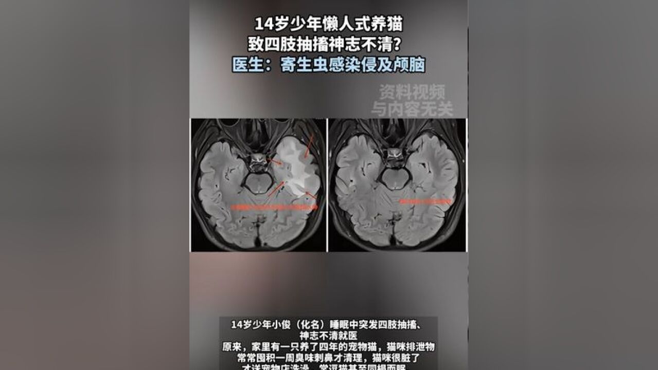 14岁少年懒人式养猫 致四肢抽搐神志不清?医生:弓形虫感染 14岁少年懒人式养猫 致四肢抽搐神志不清?