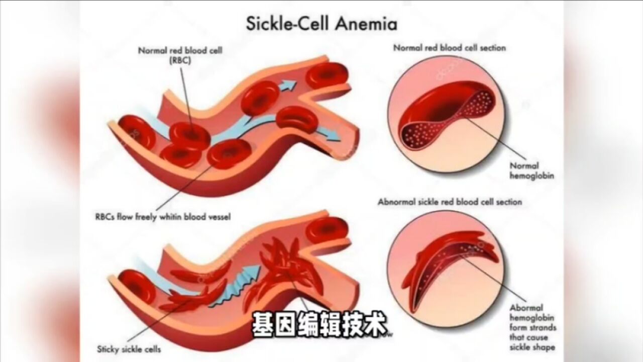 基因编辑疗法新突破,「治愈」90%以上的血液遗传病