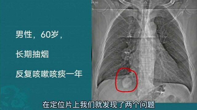 小细胞肺癌CT片怎样分析?医生讲4点,这种肺癌转移早,戒烟有益