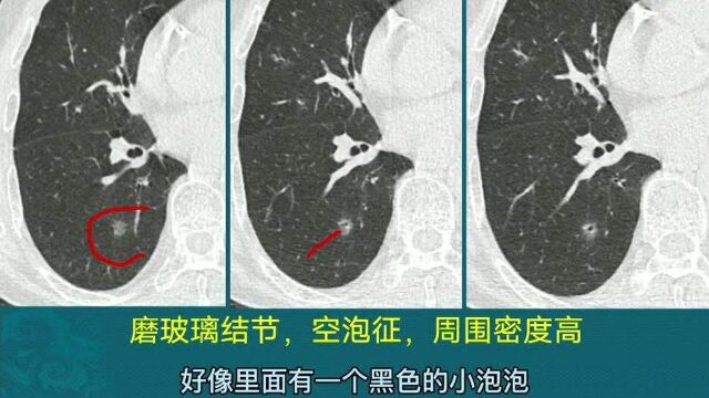 磨玻璃肺结节,这2个表现提示肺癌风险高,要及时手术