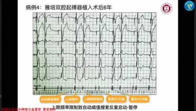 2022.01.12【漫话心电】第六十六期|吴建敏:雅培起搏器AC功能特殊运作病例分享