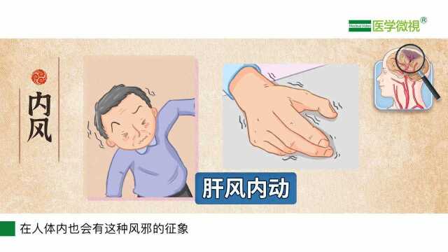 中医常说的“风邪”和脑梗死有什么关系