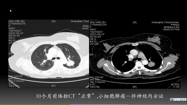 早期肺癌的诊治策略现状与挑战上海交通大学附属胸科医院叶剑定