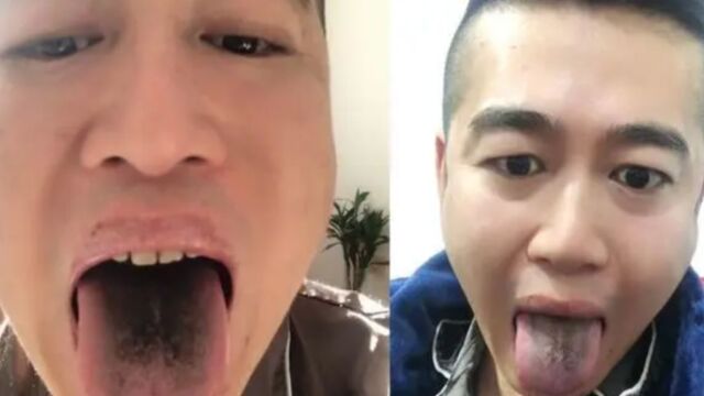 男子确诊后舌头牙齿全变黑,网友调侃:这是“黑株”