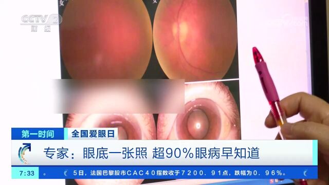 全国爱眼日 专家:眼底一张照 超90%眼病早知道