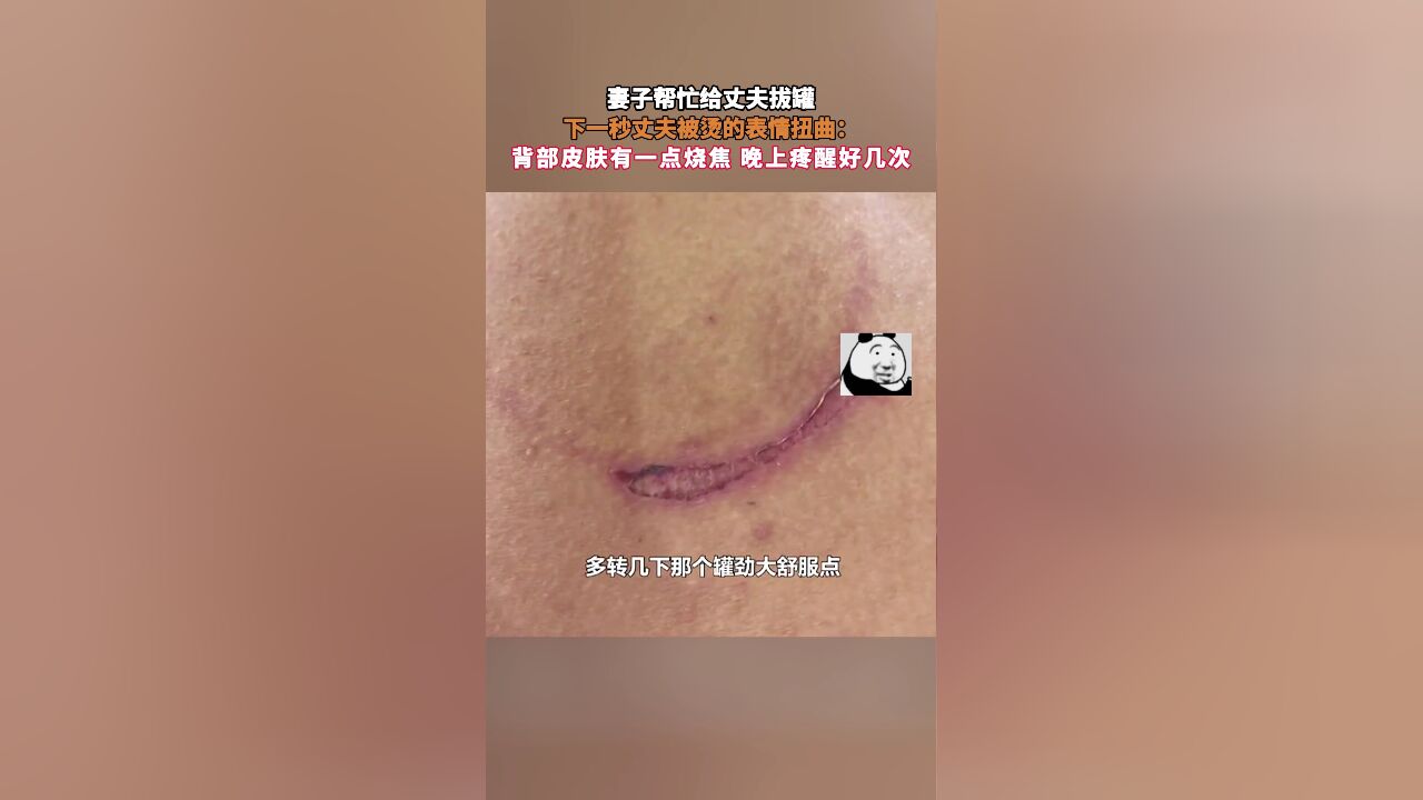 妻子帮忙给丈夫拔罐,下一秒丈夫被烫的表情扭曲:背部皮肤有一点烧焦 晚上疼醒好几次