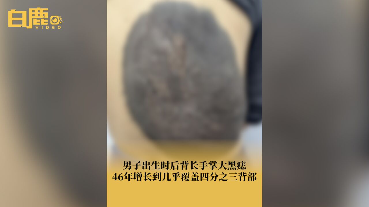 男子黑色素痣46年长满四分之三背部