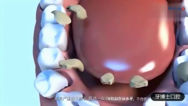 牙齿矫正全过程的3D演绎