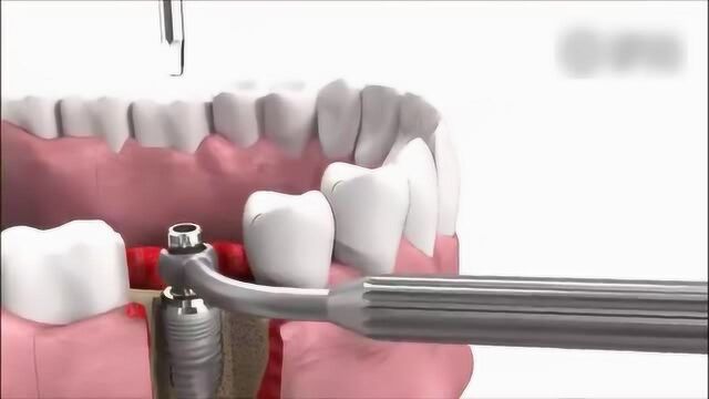 2分钟了解种牙全过程