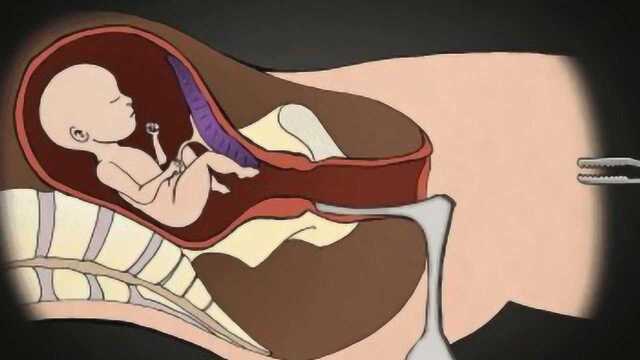 动画演示“打胎”全过程,手术场面极其残忍,让人头皮发麻!
