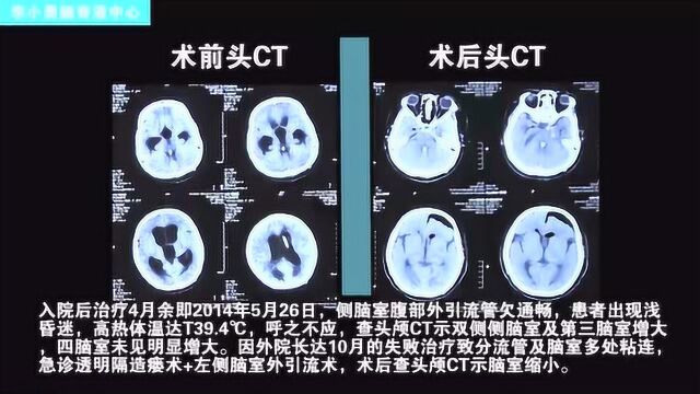 女性脑积水分流术后并发症脑室粘连,四脑室孤立扩张,如今怀孕生女