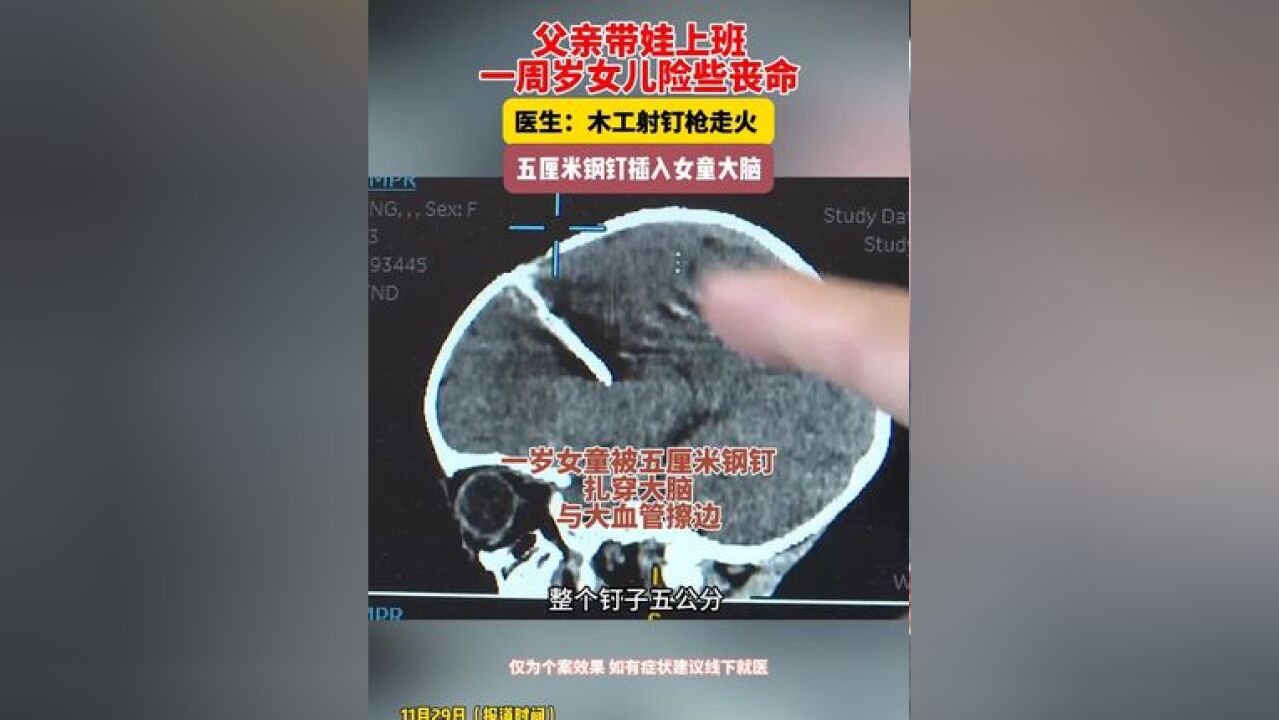 父亲带娃上班 一周岁女儿险些丧命 医生:木工射钉枪走火 五厘米钢钉插入女童大脑