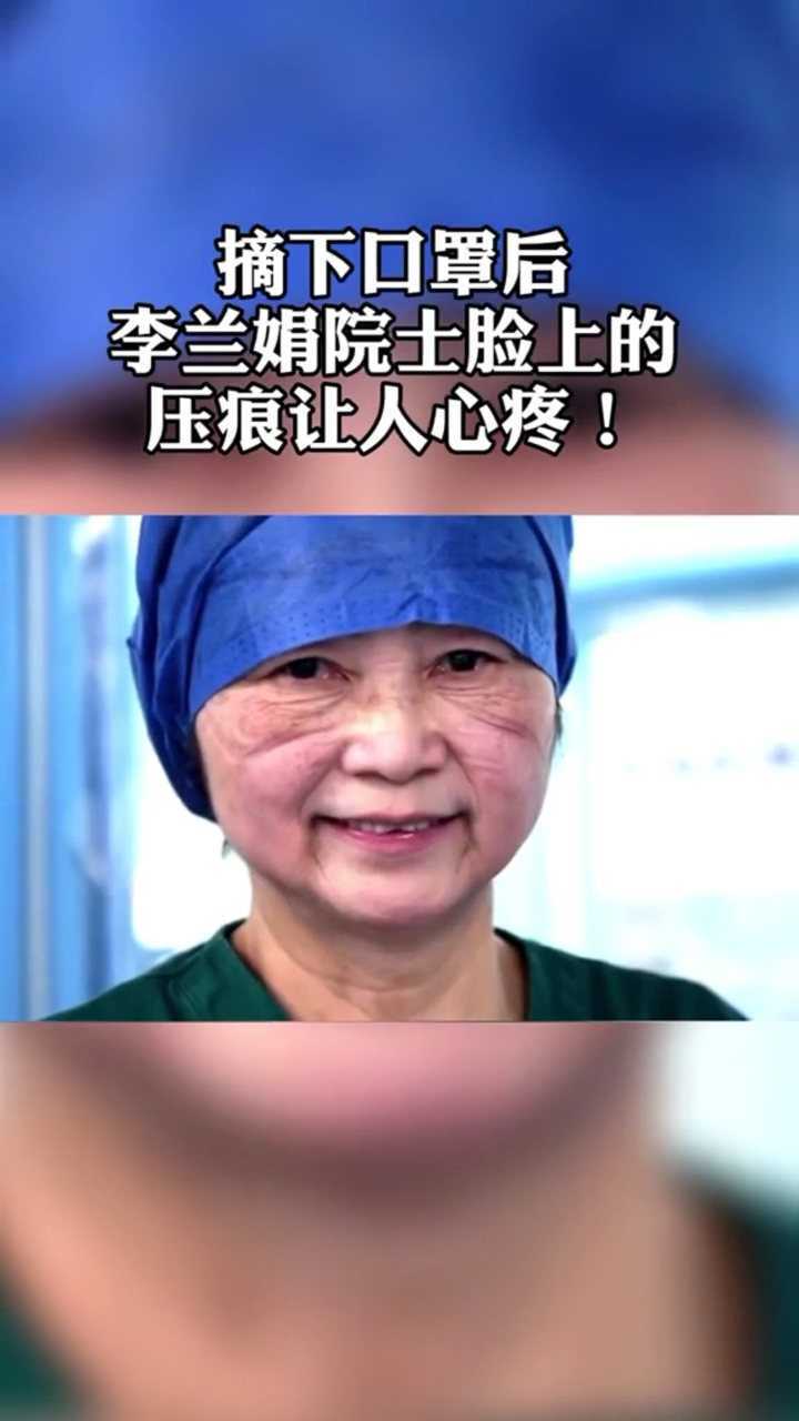 心疼!摘下口罩后,李兰娟院士脸上的压痕清晰可见,您辛苦了!