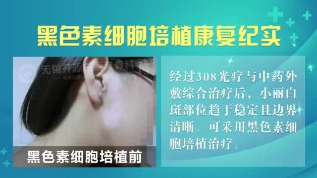 27秒带你了解黑色素培植治疗效果