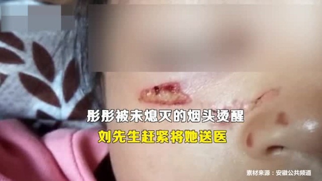 心疼!4岁芜湖女童被高空坠落烟头烫,脸上疤印清晰可见