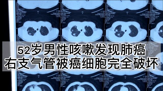 52岁男性咳嗽发现肺癌,支气管镜带你看被肺癌完全破坏的右支气管