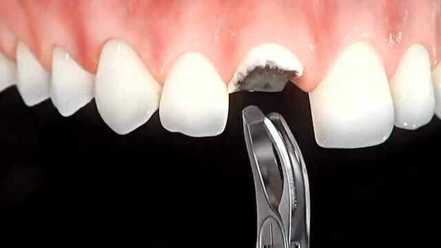 门牙修复的最好方式,3D动画演示整个过程,医学发达看着也有点恐怖!