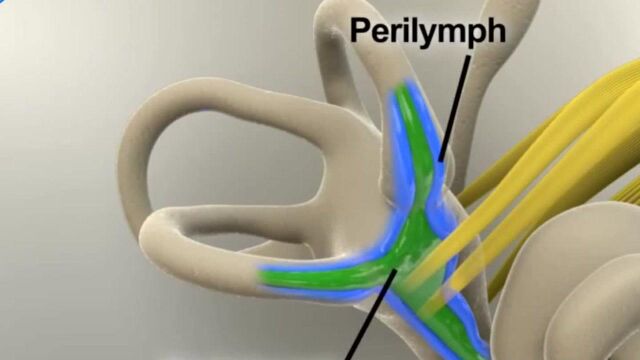 3D动画演示:梅尼埃尔氏病的治疗方式