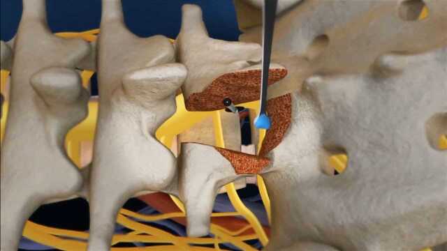 【3D动画】腰疼不要带入,腰椎融合术!