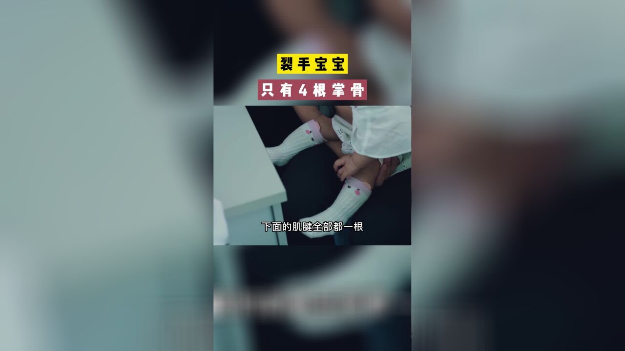 宝宝裂手畸形,只有4根掌骨