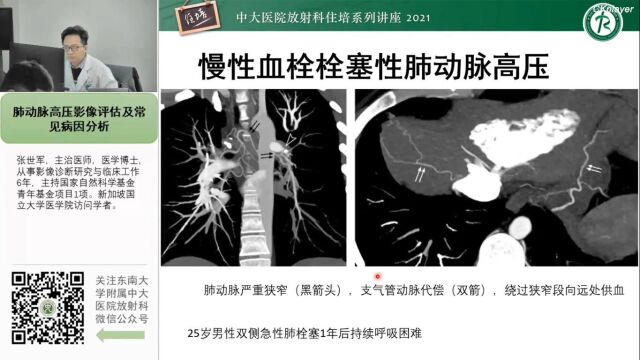 肺动脉高压影像评估及常见病因分析中大张世军