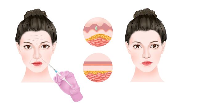 面部打玻尿酸不只填充凹陷,还有这个作用你知道吗?