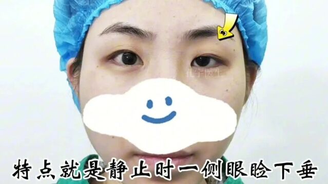 【孔宇医生:左眼先天性上睑下垂(下颌瞬目综合征)术后13月】