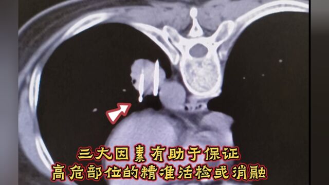 介入病例展播:三大因素有助于保证高危部位的精准活检或消融