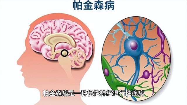 帕金森病的定义、病因和症状