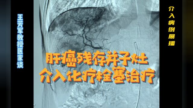 肝癌残存并子灶的介入化疗栓塞治疗