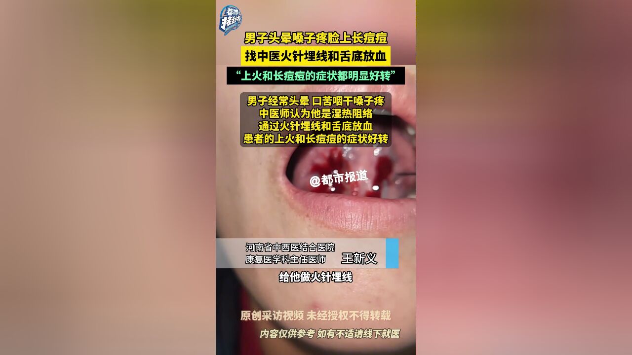 男子头晕嗓子疼脸上长痘痘 找中医火针埋线和舌底放血