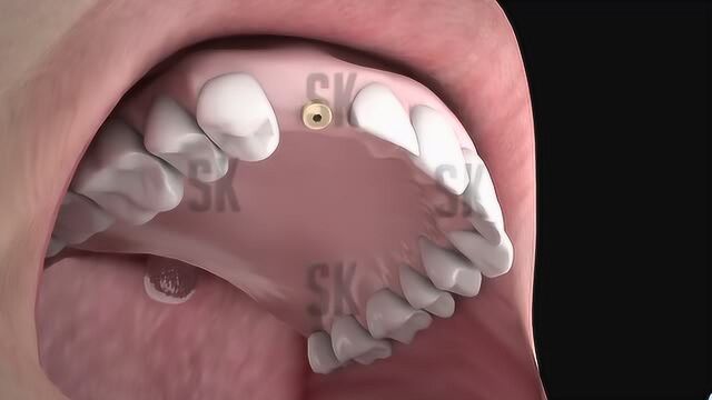 动画解析种植牙的全部过程,缺失一颗牙齿最好的修复方法!