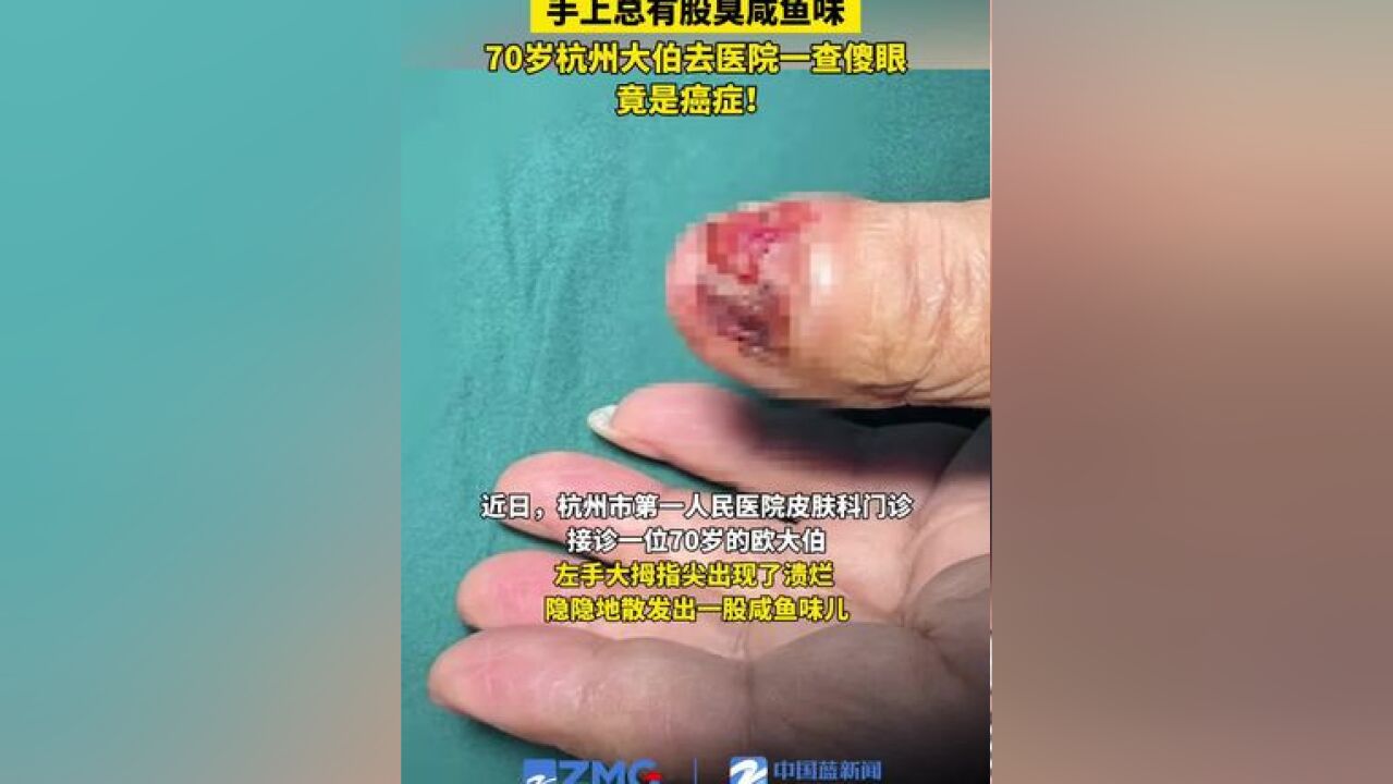 手上总有股臭咸鱼味,70岁杭州大伯去医院一查傻眼:竟是癌症!原来两年前大伯曾就诊,但怕麻烦,说自己涂涂碘伏就好,就错过了最佳治疗时间,目前,...