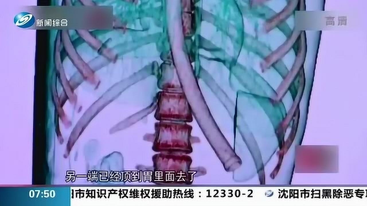 真狠女孩为减肥用30厘米硬管催吐不小心吞入肚中末端顶到胃里