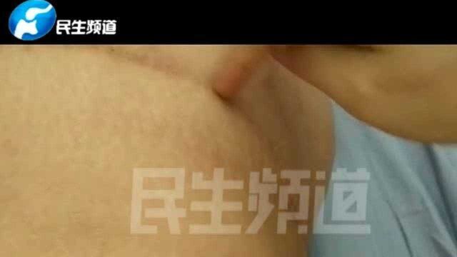 女子想“变美”,做腹壁整形术竟把肚脐“变没”?女子苦恼不已