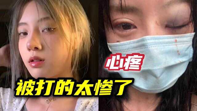 24岁女网红惨遭家暴,鼻青脸肿口罩全是血,网友却大骂活该