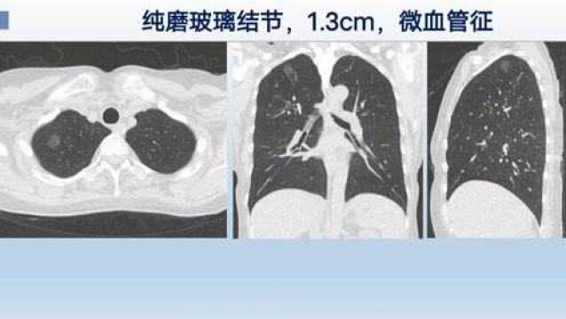 3种肺结节需要手术,已突破原位癌,CT片3个小细节