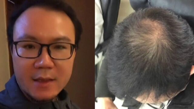 男子秃顶求医无效,半个月不用洗发水后竟长出头发:又粗又硬