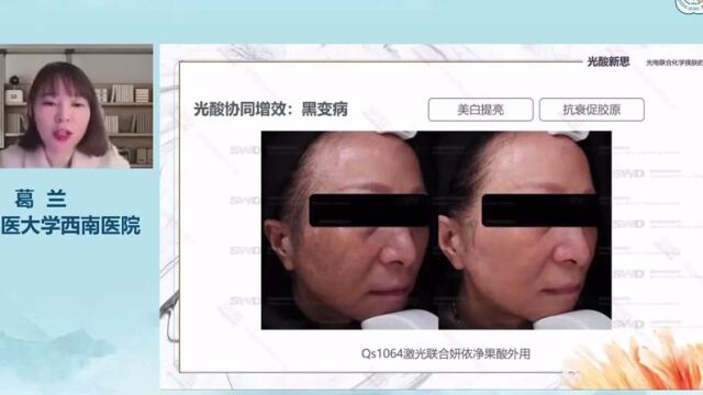 重庆西南医院葛兰教授妍依净 化学焕肤