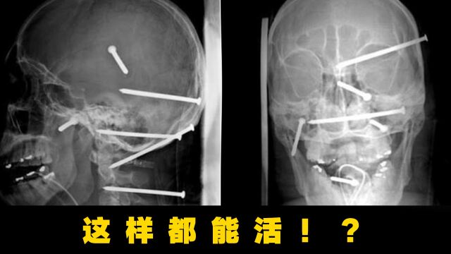 死神之镰下的几条漏网之鱼!长钉穿脑过,人却还能活?