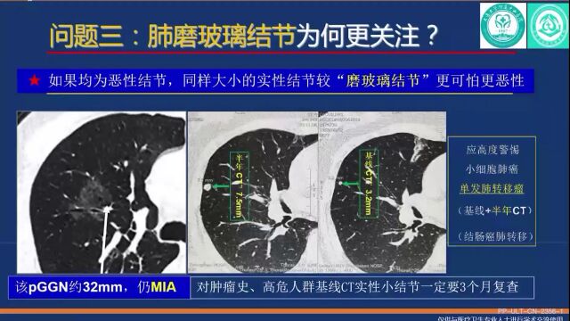 伍建林教授丨关于肺结节十大热点问题(二)肺磨玻璃结节为何如此受关注?