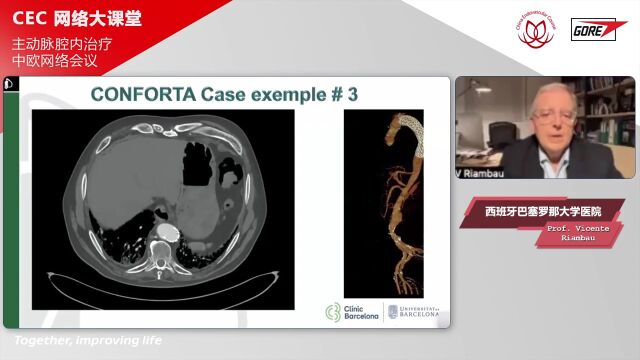 精彩荟萃「CEC 网络大课堂」主动脉腔内治疗中欧网络会议