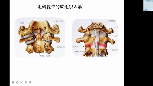 经口咽截骨改造,松解复位内固定术治疗复杂型难复性寰枢椎脱位及颅底凹陷症