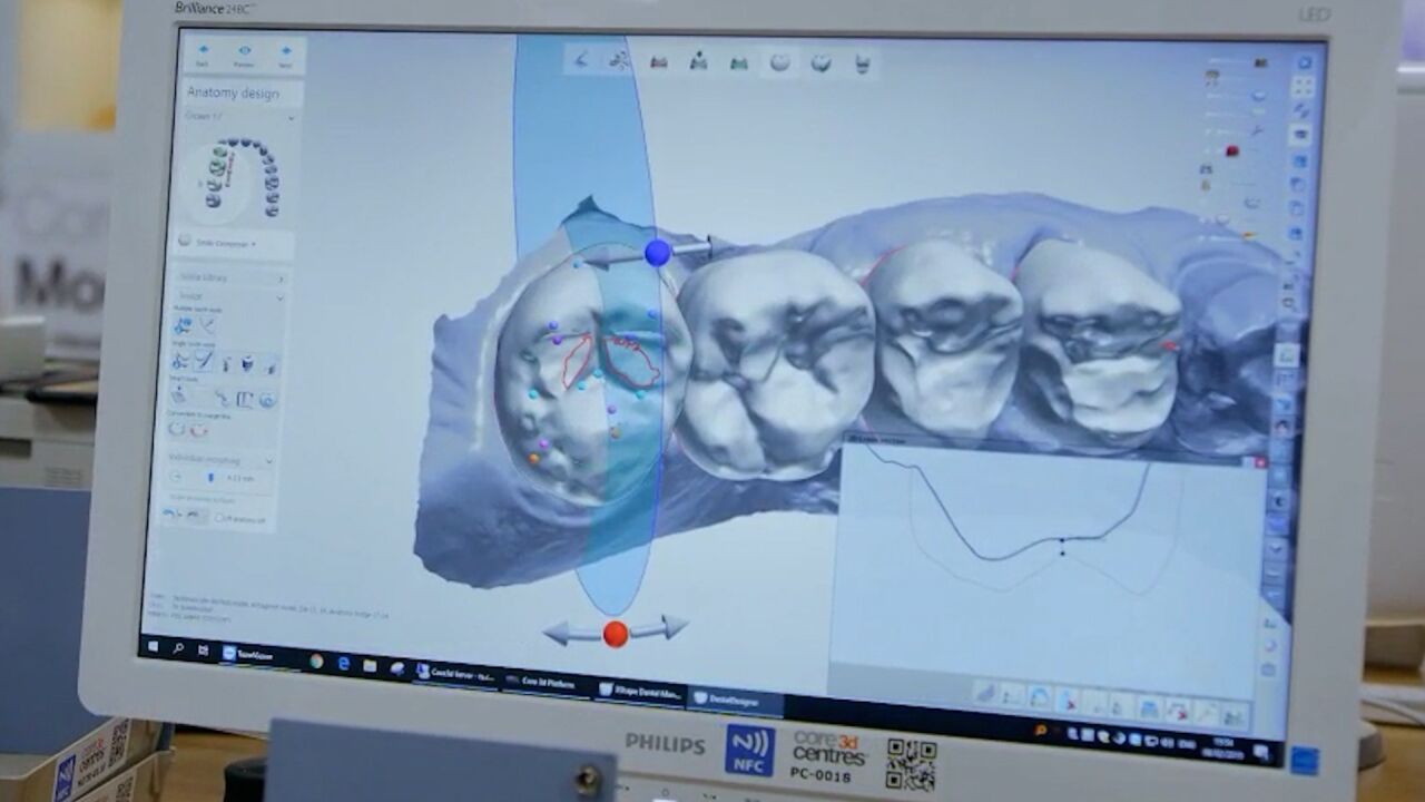 深圳产的义齿远销海外:3D打印、数字转型展现“广东智造”