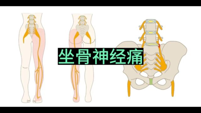 命门穴|坐骨神经痛