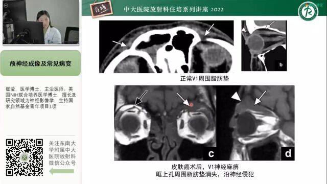 颅神经成像及常见病变中大崔莹