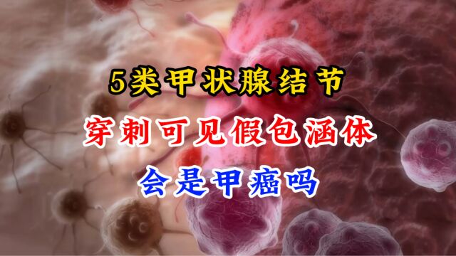 5类甲状腺结节,穿刺可见假包涵体?医生:没事,不一定就是甲癌