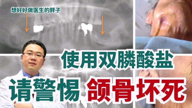 医生提醒:使用双膦酸盐类药物抗骨松患者,请关注颌骨坏死风险